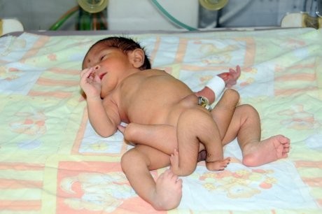 Un Bébé Pakistanais est né avec ...  Six  Jambes ! 